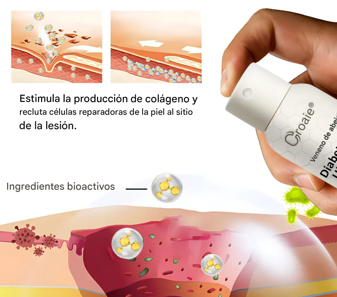 Espray para úlceras del pie diabético con veneno de abeja