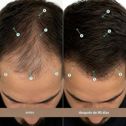 Sérum Avanzado De Densidad Capilar Con Nanoxidil 5%
