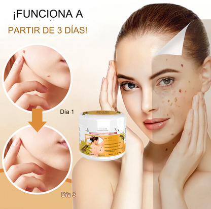 PROMO 2X1 🔥🐝 Crema para el tratamiento de lunares y verrugas con veneno de abeja Lenaro