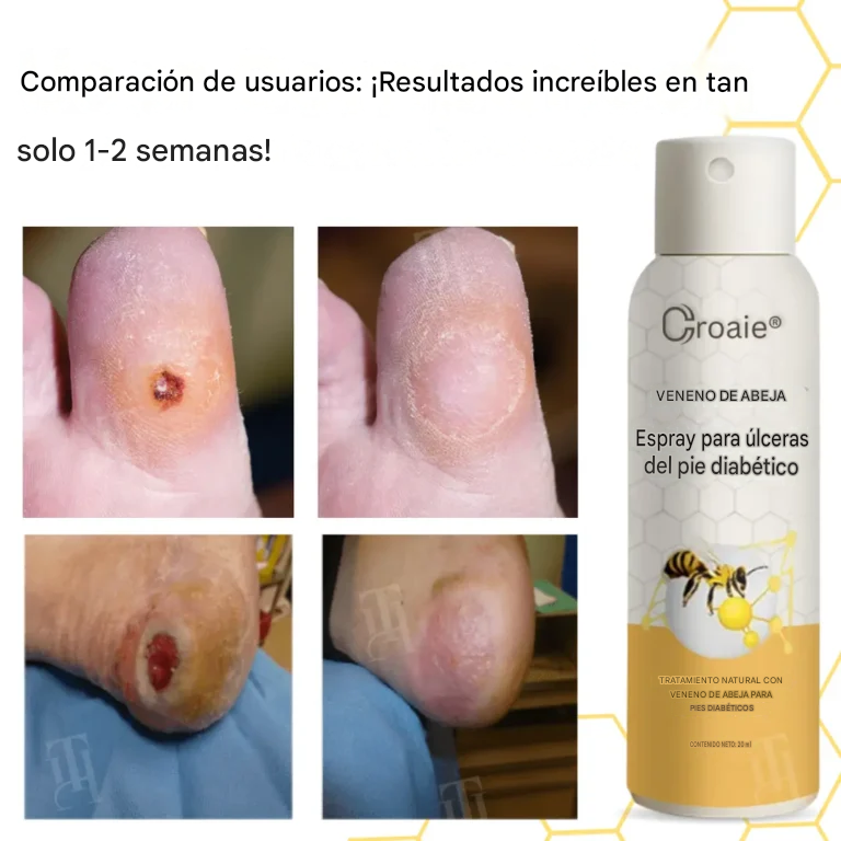 Espray para úlceras del pie diabético con veneno de abeja