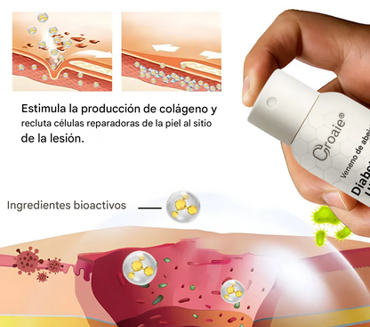 Espray para úlceras del pie diabético con veneno de abeja