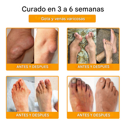 PROMO 2x1 - Crema Para La Curación De Huesos Y El Alivio Del Dolor Con Bótox