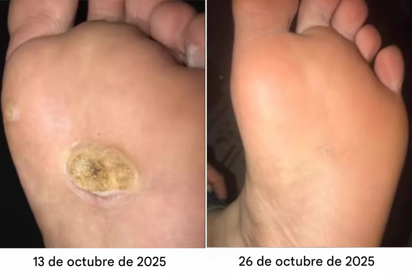 Crema Removedora De Callos Y Durezas Con Veneno De Abeja