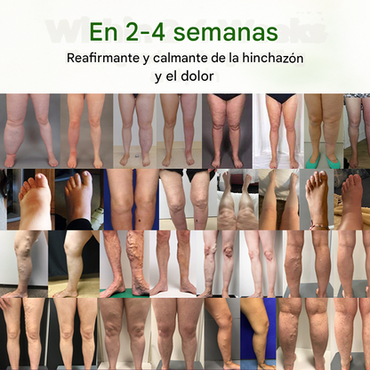 Crema para pies antiedema "FluidEase" de Timilk® — ✅ ¡Clínicamente probada para eliminar las venas varicosas en solo 7 días!