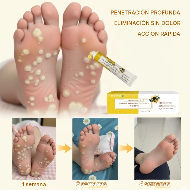 Crema Removedora De Callos Y Durezas Con Veneno De Abeja