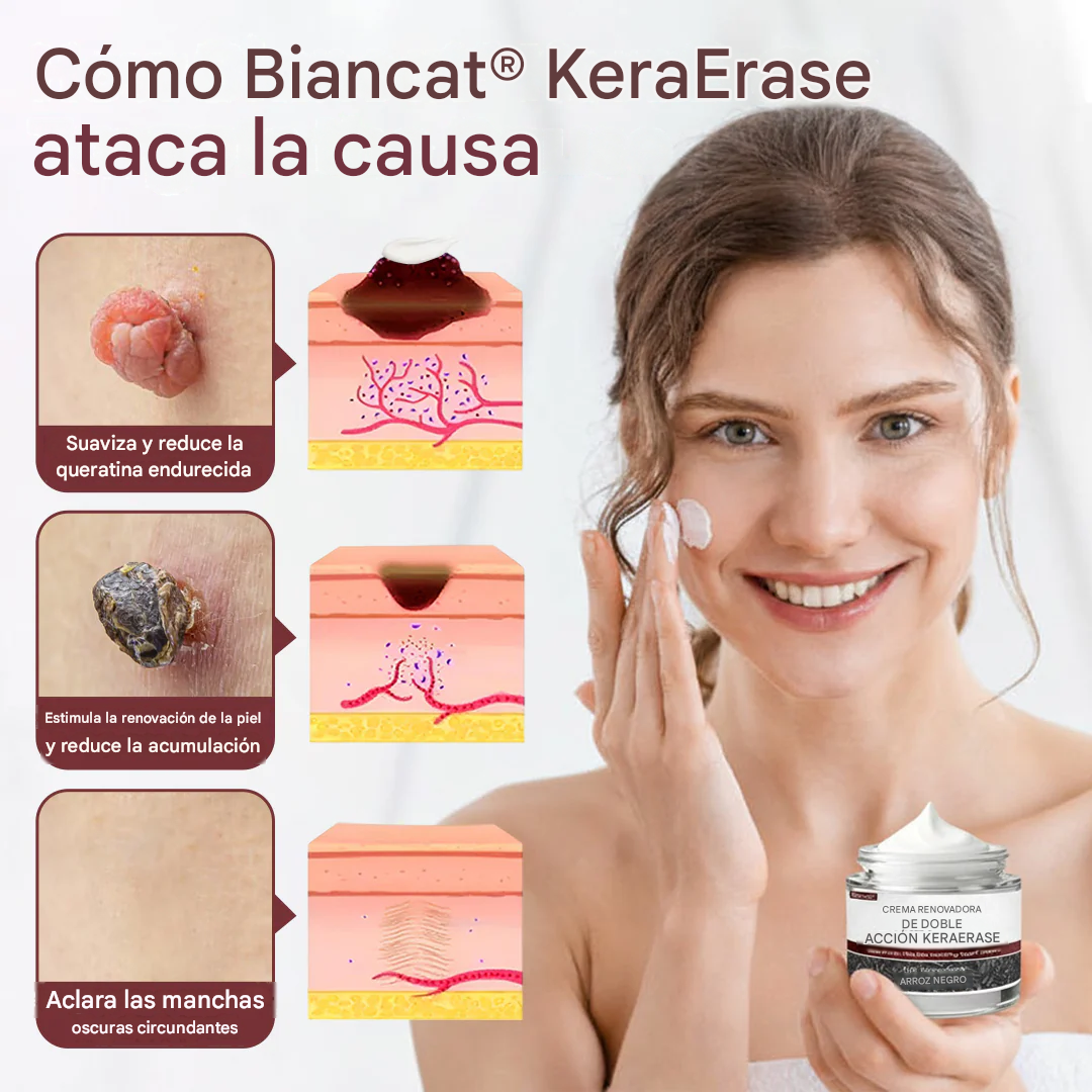 KeraErase ®Crema Eliminadora De Verrugas