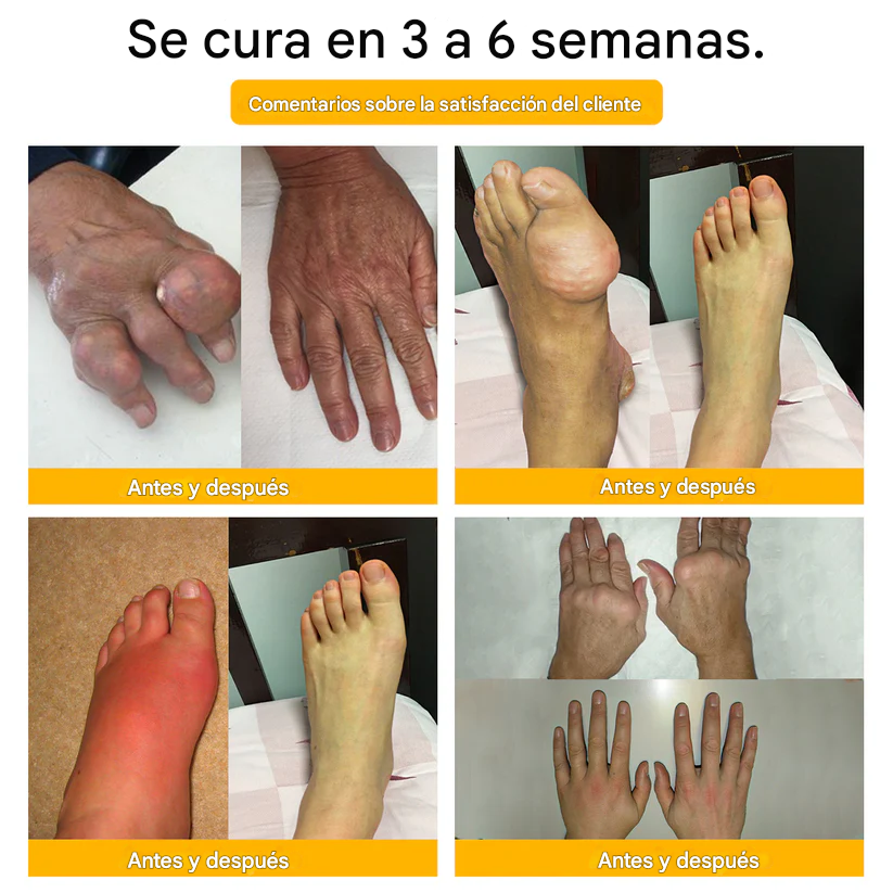 PROMO 2x1 - Crema Para La Curación De Huesos Y El Alivio Del Dolor Con Bótox