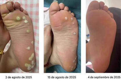 Crema Removedora De Callos Y Durezas Con Veneno De Abeja